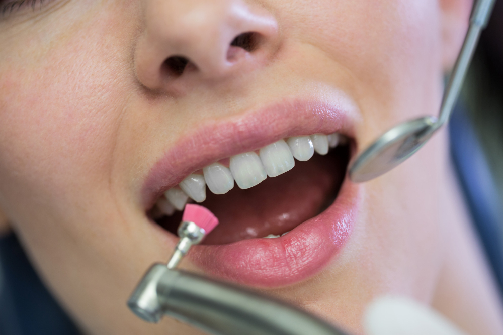 Close-up of dentist polishing veneers for smooth and shiny finish in Denver clinic.