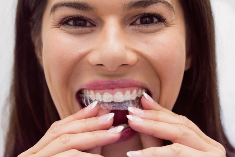 Woman inserting aligners as part of Invisalign in Denver treatment.