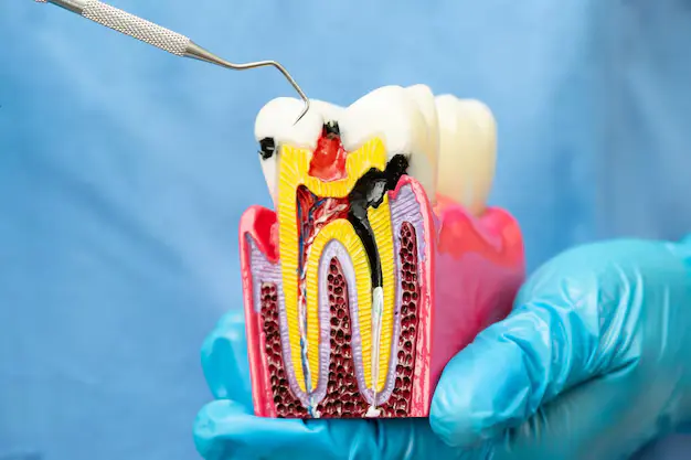 Detailed dental model showing infected pulp treated during Root Canal Therapy in Denver.