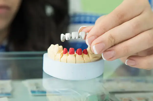 Hand placing a dental bridge on a model to demonstrate Restorative Dentistry in Denver.