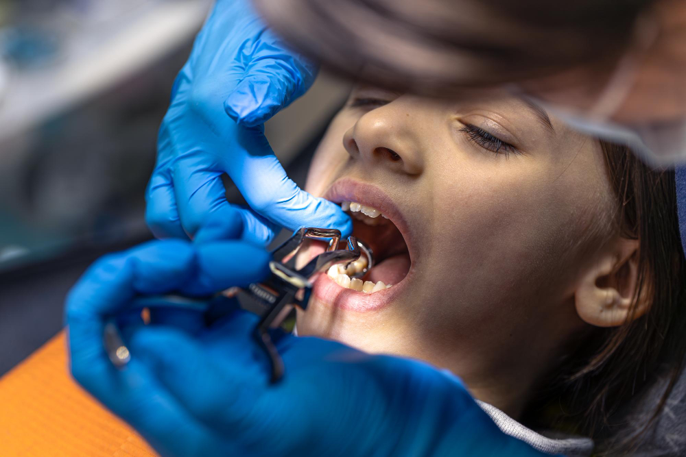 Close-up of a patient receiving a fitted oral appliance during treatment in Denver.