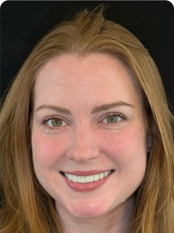 After cosmetic dentistry, front view