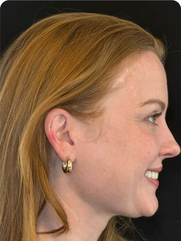 After cosmetic dentistry, profile view